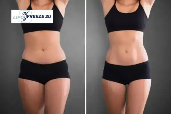 How Can LIPO FREEZE 2U Support Your Post-Pregnancy Body Recovery Mansfield?