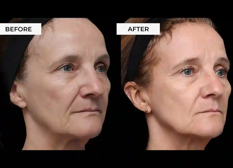 How Many RF Microneedling Sessions Will You Need to See a Difference Mansfield?