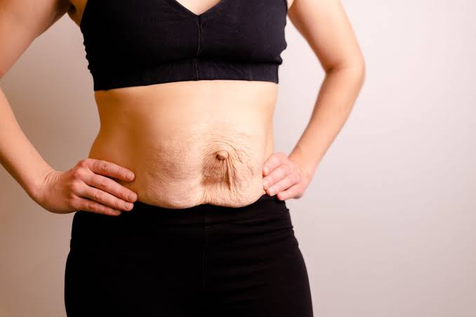 Is Surgery Really the Only Way to Repair Diastasis Recti Mansfield?