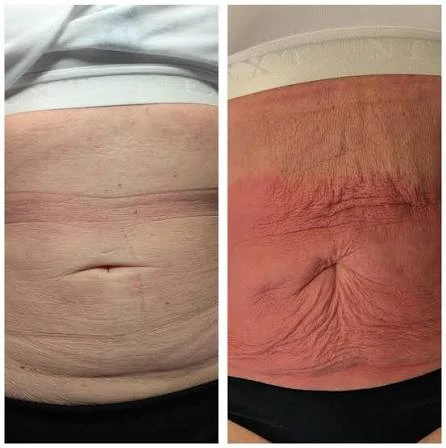 How Does RF Microneedling Improve Crepey, Thin and Uneven Skin Texture Mansfield?