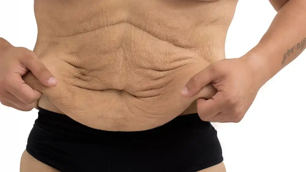 Why Does Weight Loss Medication Leave Some People With Loose or Sagging Skin Mansfield?